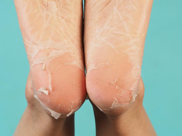 Skin Peeling Off Bottom Of Feet Home Remedies